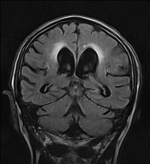 Patients With Idiopathic Normal Pressure Hydrocephalus Student: