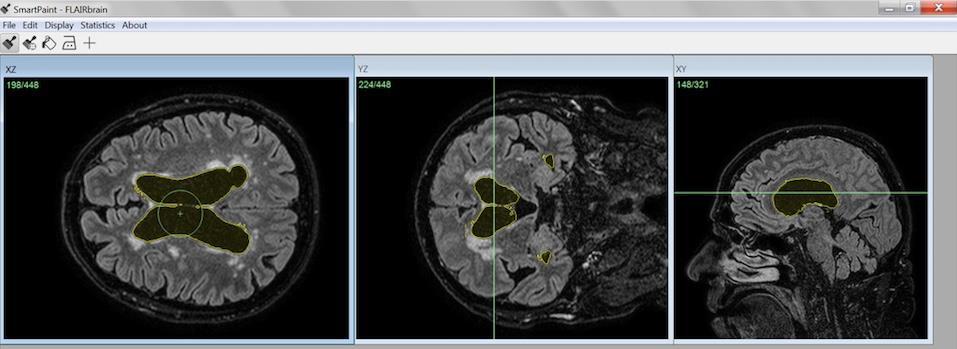 17 (38) The brush tool feature of SmartPaint was used in this study. This tool allows the user to operate completely manually and to perform all segmentations by free hand.