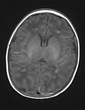 在缺氧缺血脑组织的早期 由于细 胞膜 Na+ K 泵功能障碍 形成细胞毒性脑水肿 使细胞 内结合水分子的弥散受限 ADC 值降低 在 DWI 图像 上表现为高信号 6 所以 在对常规 MRI 序列表现为 图1 PWML 的患儿同时进行 DWI 和 SWI 检查有助于鉴别 PWML 的发病原因 3.