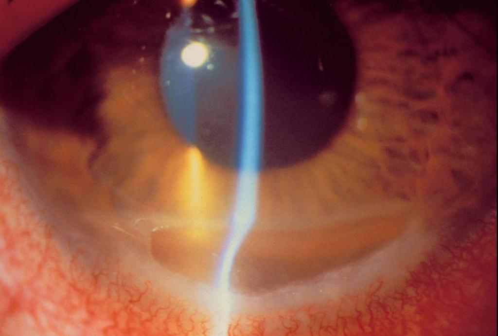 Perifer Ulcerativ Keratit Ögonvärk, rodnad, epifora, ljuskänslighet och synnedsättning Konjunktival, episkleral och skleral inflammation Samtidig sklerit