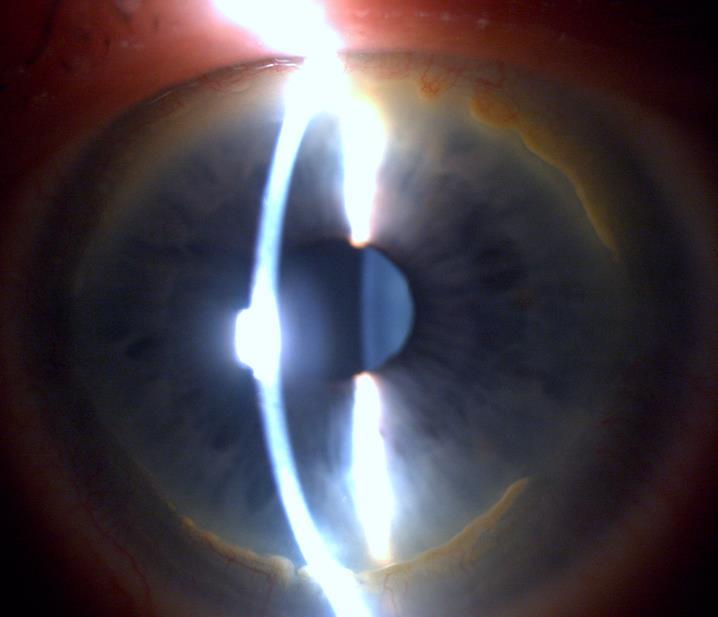 Terrien s marginal degeneration Bilateral ofta asymmetrisk, icke