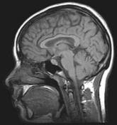 MR Imaging for Evaluation of Unspecified Headache without neurologic abnormality Study Type of headache Type of study No.