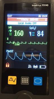 Patient Care & Monitoring Systems 4/5 FSN86201749A September 2016 ÅTGÄRDER SOM BÖR VIDTAS AV KUNDEN/ANVÄN DAREN Till dess att programvaran har uppgraderats måste du se till att den lokala