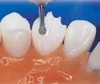 5 long p Needle Edenta Rosenborr Ståborr till exkaverings STEEL STAHLBOHRER Finns i stl 05-40 ant fattning. DiamonD Normalpris: 1 Diamant Stl 05-23...36:Kugel Round Stl 25-31...74:Boule Stl 33-35.
