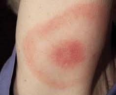 Erytema migrans Borrelia Burgdorferi Klinisk diagnos Erytem > 5 cm Ringformat utslag Diagnos efter 14