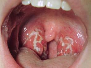 Varför behandlar vi tonsillit? 1. Symtomlindring 2.