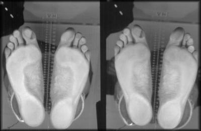 Proprioception Från :mioupet pressorreceptors in plantar surface huden