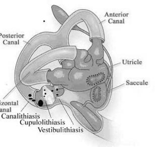 Pathways through thalamus Vestibular lesions may reduce the size of