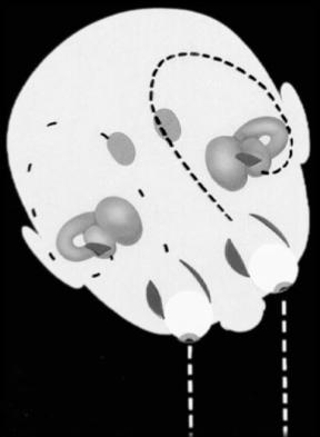 Vaskulär yrsel Neurodegenerativa sjd Ångest/depressions tillstånd