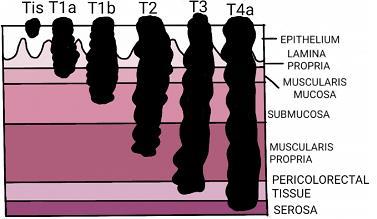 14 Presentation and Morphology of CRC Tumor-Node-Metastasis Classification AJCC 8 th and 7 th Edition AJCC 5 th and 6 th Edition T (primary tumor) TX Primary tumor cannot be assessed Primary tumor