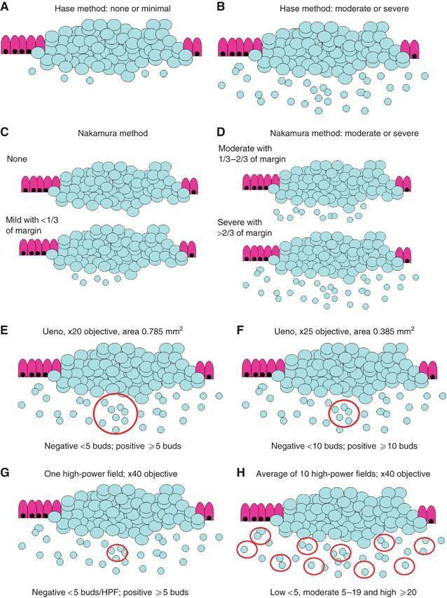 Prognostic / Predictive Factors in CRC 45 Figure 9. Visualisation of proposed tumor budding scoring systems. (Reprinted, with permission, from Lugli et al, British journal of cancer 2012).