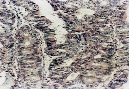 Examination was done under a light microscope and scored by two independent observers (KÖ, MH, DE) who were blinded to clinical and pathological data.