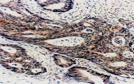 The internal positive control used was the intact nuclear staining of normal tissue (including nonneoplastic stromal cells and lymphocytes) adjacent to the tumor.