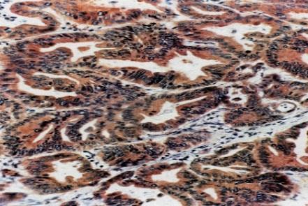 For Paper II-IV, the IHC method was used to detect MMR protein expression of MLH1 and MSH2 and when confirmation was needed of MLH1 deficiency even some cases of PMS2 were analyzed due to the known