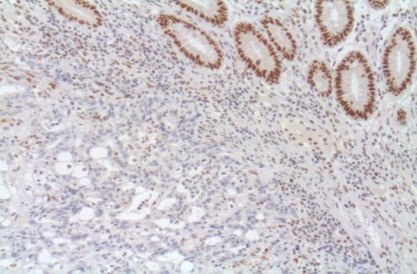 Materials and Methods 63 is responsible for the loss of protein expression of MLH1.