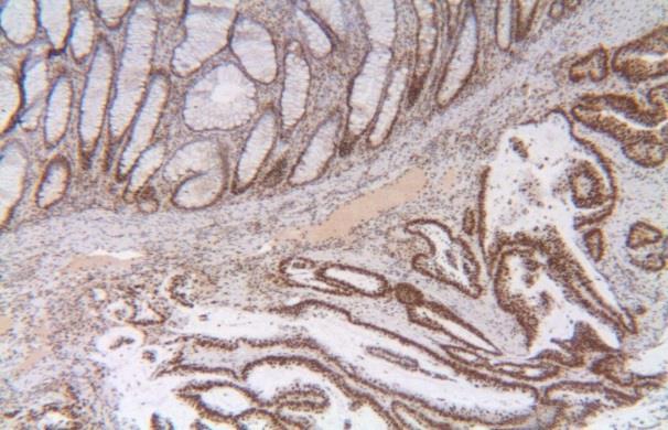For Paper IV MMR status was available for 454 (95%) of the 478 colon cancer cases. MLH1 negative Figure 14. Illustration of IHC staining for MLH1. MLH1 positive 9.3.