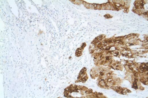 tumor budding. The methods either had a qualitative approach or a quantitative approach.