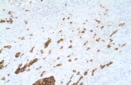 avoid their underestimation. Consultation was done with a pathologist before Paper III to establish a suitable method for quantitative assessment of tumor budding.