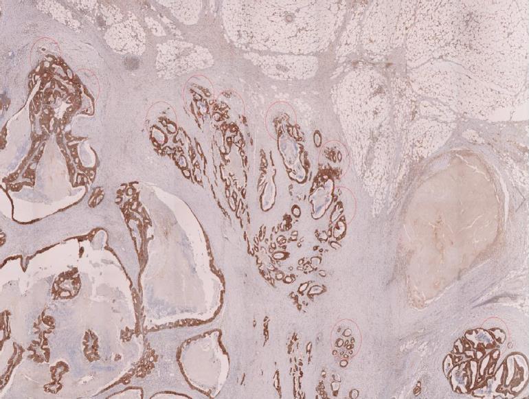 Materials and Methods 65 The digital images were reviewed by two independent investigators (MK and AM) blinded to the clinical and pathological data.