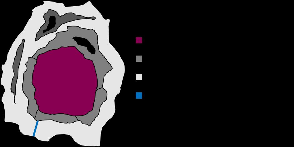 Retrospektiv EM biopsistudie (Samuelsson et al.