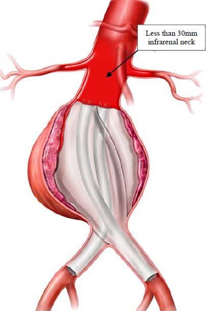 med kommersiellt tillgängliga stentgrafter i de Viscerala artärerna (när < 30 mm av den infrarenala halsen är åtkomlig).