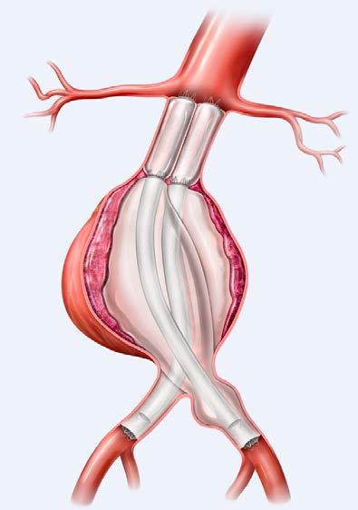 Figur 5 visar en illustration efter behandling med Nellix proximala förlängare, och figur 6 visar en illustration