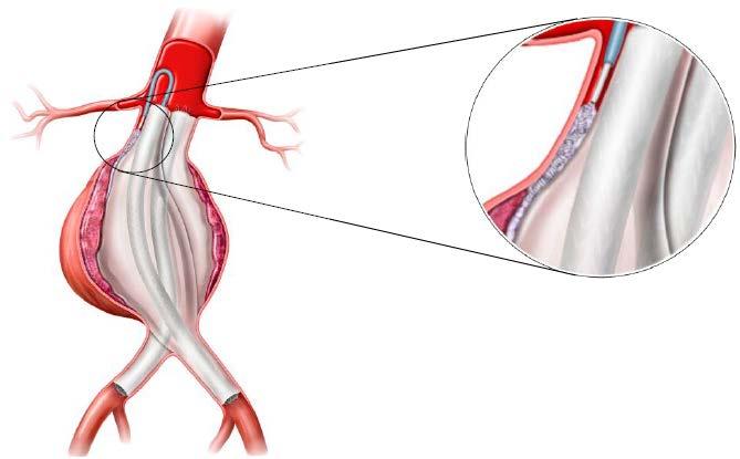 Figur 9 visar en illustration efter behandling med enbart spiraler och vätskeemboliskt material, och figur 10 visar en illustration efter behandling med spiraler, vätskeemboliskt material och