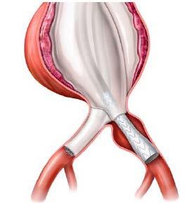 Figur 11 visar en illustration av endoläckage av typ Ib som lämpar sig för distal förlängning, och figur 12 visar en illustration efter behandling med distala förlängare.