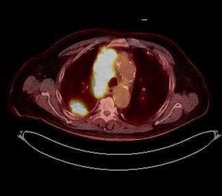 PET-CT