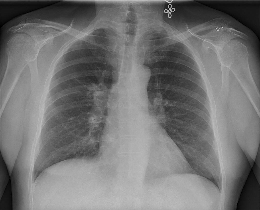 Lungröntgen p.g.a.