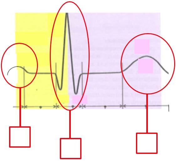 4. Cirkulationssystemet Kodnr. Föreläsare: Anna Dieden (Max 10 p) 1) Fyll i rätt siffror i rutorna vid EKG-komplexet 1,5p 1) T-våg 2) D-våg 3) P-våg 4) QRS-komplex 5) V-komplex 2.
