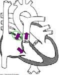 Kir slutning med GoreTex-patch. Persisterande duktus arteriosus (PDA): Systo-diastoliskt blåsljud. Machinery murmur, PM I2 sin. Ökat lungblodflöde. Beh: Prematurer: Ibuprofen, kir.