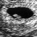V6: Gulesäck Gulesäck Missed abortion CTG (kardiotokografi): Huvudsaklig förlossningsövervakning. Antenatal + intrapartal övervakning. Identifiera foster med ökad risk för hjärnskada.