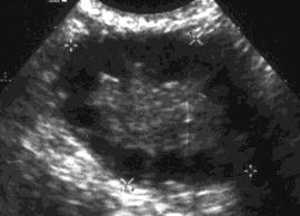 Punktion kan möjliggöra vaginal partus om cystan bedöms som förlossningshindrande men leder ofta till recidiv. Op-ind: Malignitetssuspekta fynd, storlek >8 cm, symtomgivande cysta. Op v7-24.