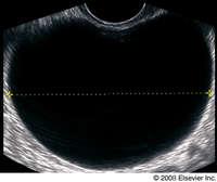 Malign ovarialcysta (typisk ekrescens) 9.