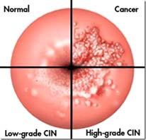 Skreening: 23-50 år kallas vart 3:e, 50-60 år vart 5:e, år till MVC för ta gyncellprov. Cellprov från cylinder-, skivepitel. HPV når lättast omogna celler i metaplastiska området.