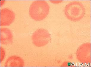 Diff diagnoser Anemi pga inflammation/infektion Både TIBC och S-Fe sänkta MCV normalt Trc normala/förhöjda Ferritin förhöjt Hepcidin förhöjt Talassemia Minor