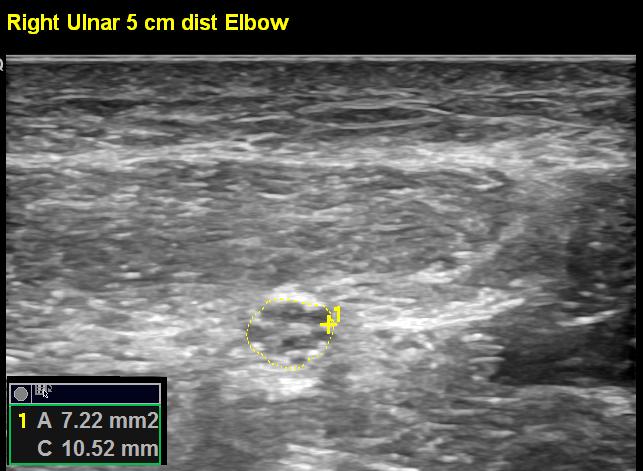 ligament, osteofyter, metallstift/-skruvar etc 1.