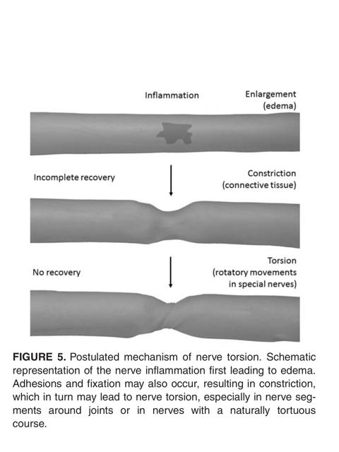 4d: Neurografi normal EMG: bortfall av muskelaktivitet 2 w: Neurografi: normal förutom bortfall av n cut