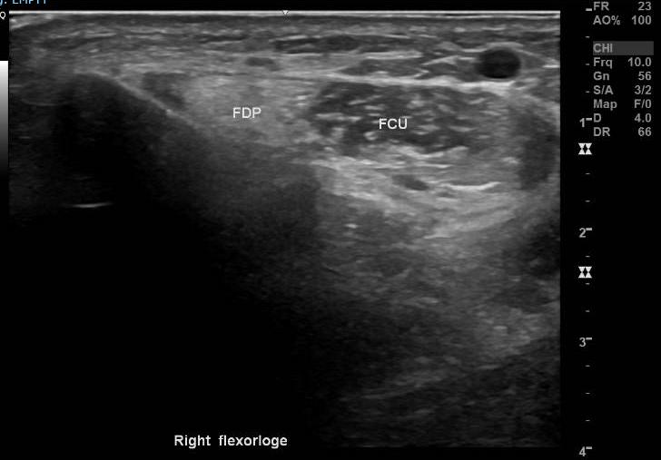 myopati, Welanders Neurogent, MMN Vingscapula, vuxen -Patienten svimmade vid EMG, EMG gick ej