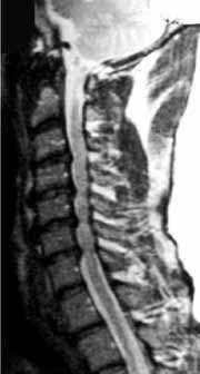B. Förträngning av ryggmärgen i halsryggen Varför utförs operationen? Om ryggmärgen är klämd (fig. 3) kan det ge varierande symtom, både från armar och från ben.