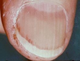 Hudsymtom vid endokardit Splinter hemorrhages Sagitalt under naglarna 10-25 % av fallen, dock