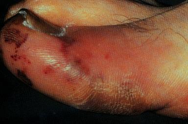 Hudsymtom vid endokardit Janeway lesions Små (<5mm) på handflator/fotsulor Bleknar vid tryck,