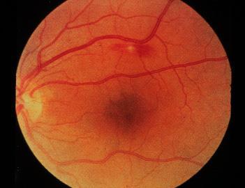 Ögonsymtom vid endokardit Roth spots Nära macula Hemorrhagisk,