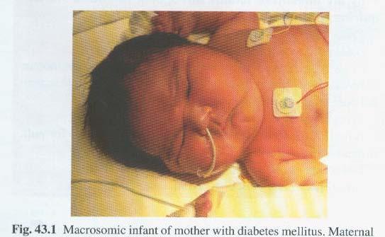 Det nyfödda barnet Risk för neonatal hypoglykemi, (pga hög