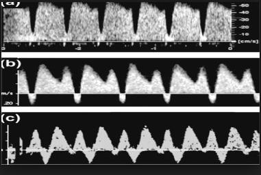 Pulsad doppler i ductus venosus M-formad flödesprofil A-våg minskar vid påverkan A-våg < 0 =