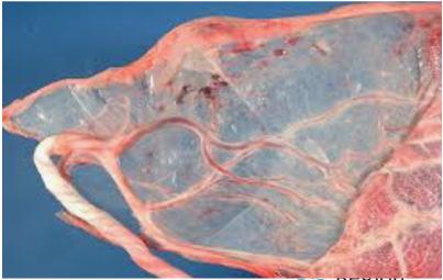 Placenta risk IUGR Single umbilical artery