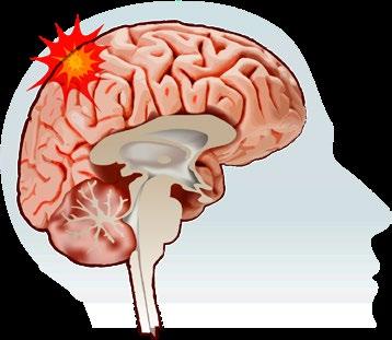 CG01-projektet CombiGenes epilepsiprojekt CG01 utvecklas för behandling av svårbehandlad epilepsi.