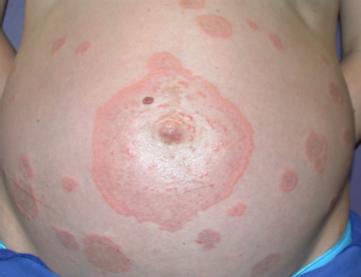 pregnancy) Prurigo gestationis PFP