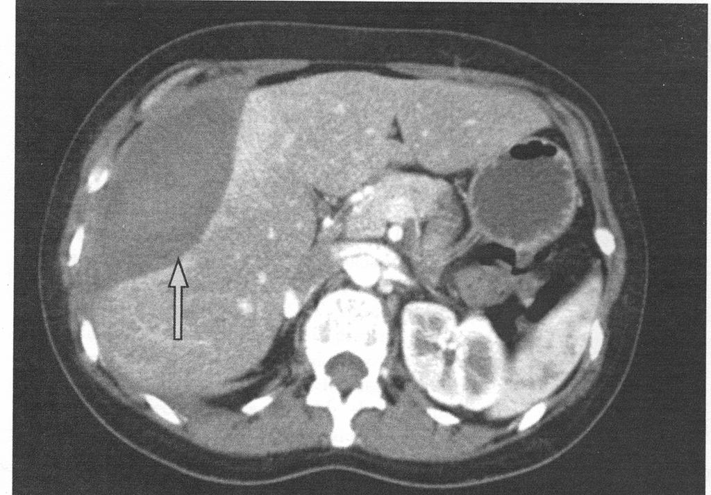 HELLP - komplikationer Organblödningar DIC (5-50 %) Leverruptur (1-2 %) Ablatio placenta (10-20 %) Akut